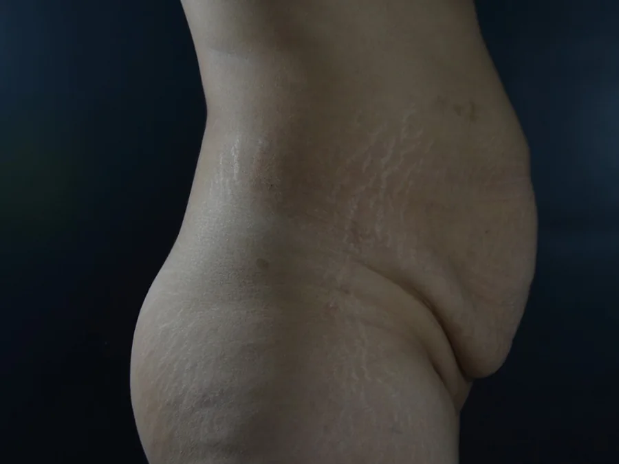 Perfil del abdomen antes de la cirugía de contorno corporal
