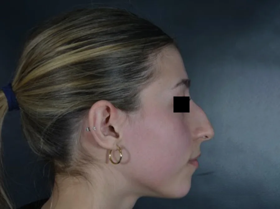 Perfil de nariz antes de la rinoplastia